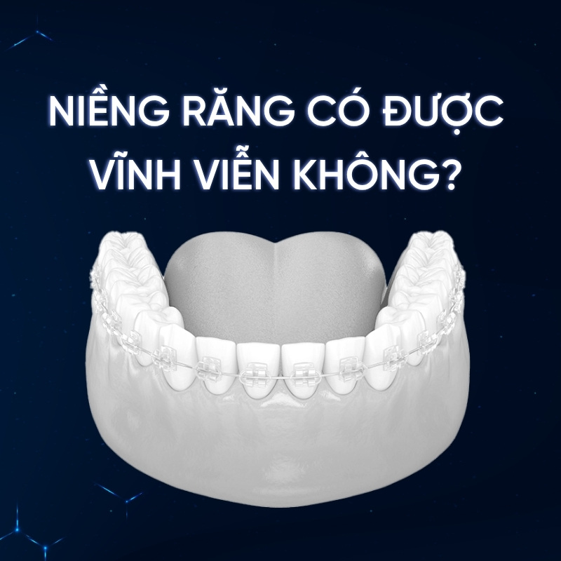 Niềng răng có được vĩnh viễn không smilux dental