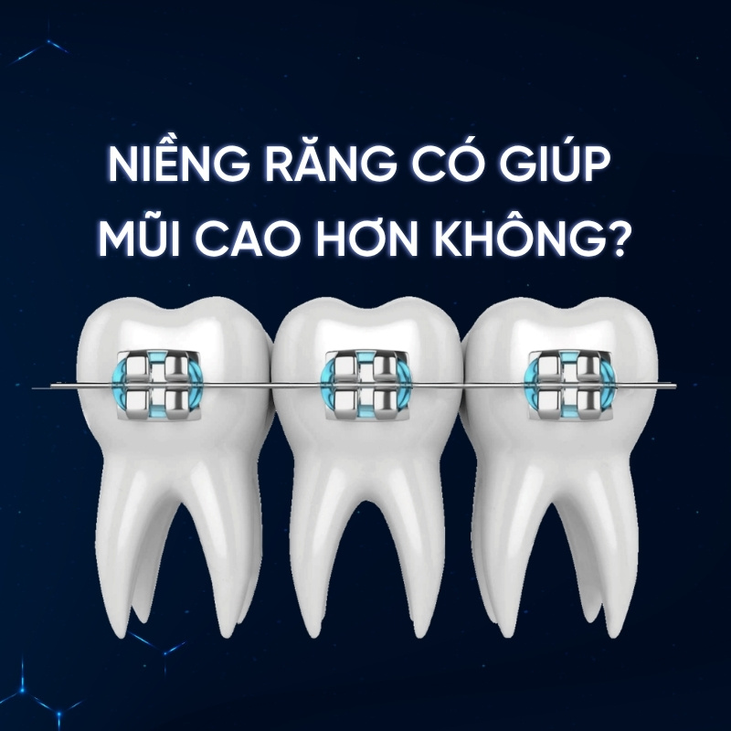 Niềng răng có giúp mũi cao hơn không smilux dental