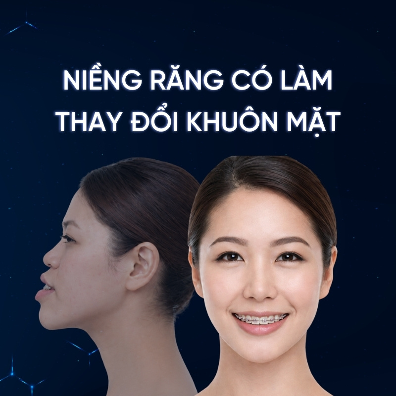 Niềng răng có làm thay đổi khuôn mặt không smilux dental