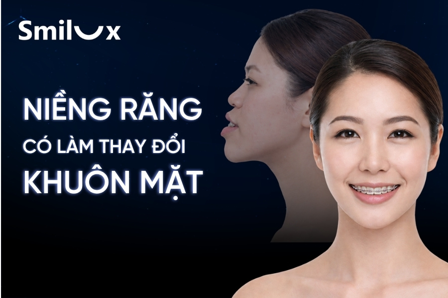 Niềng răng có làm thay đổi khuôn mặt không? Góc nghiêng trước và sau Niềng răng có làm thay đổi khuôn mặt không? Góc nghiêng trước và sau