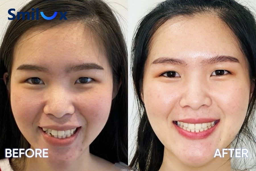 Niềng răng có làm thay đổi khuôn mặt Niềng răng có làm thay đổi khuôn mặt