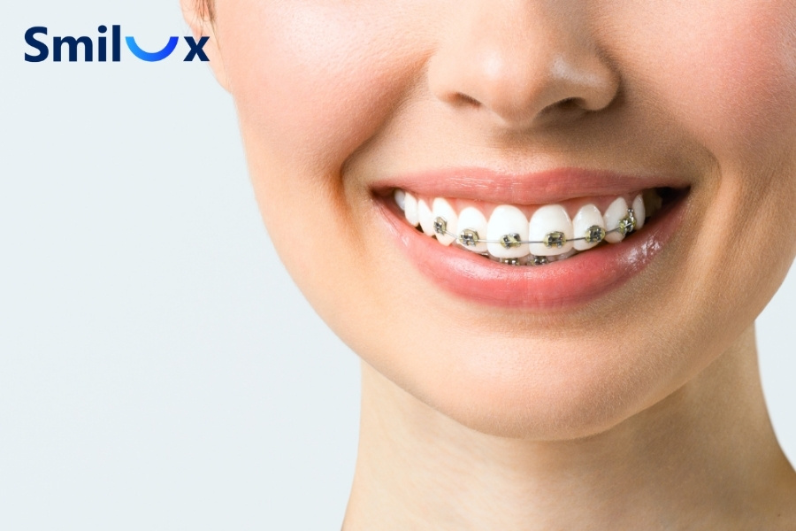 Niềng răng không bắt buộc phải nhổ răng Niềng răng không bắt buộc phải nhổ răng