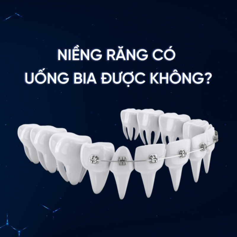 Niềng răng có uống bia được không?