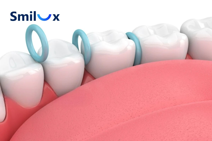 Giai đoạn đặt thun tách kẽ gây căng tức nhẹ và hơi vướng khi nhai Giai đoạn đặt thun tách kẽ gây căng tức nhẹ và hơi vướng khi nhai