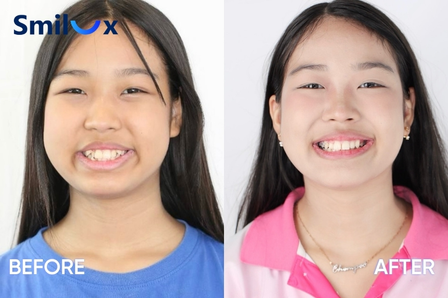 Niềng răng thay đổi khuôn mặt ở trẻ em Niềng răng thay đổi khuôn mặt ở trẻ em