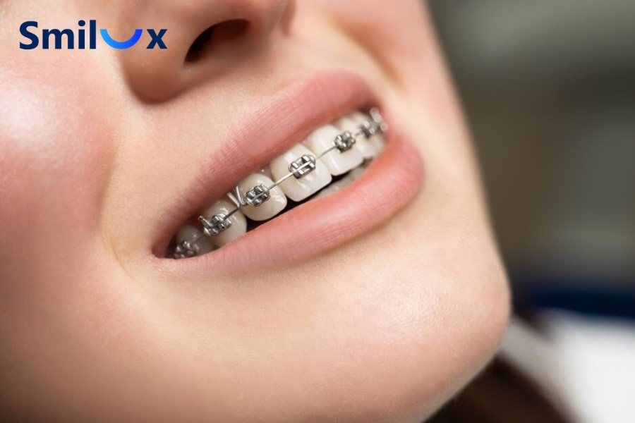 Răng chết tủy có niềng được không? Câu trả lời là CÓ THỂ Răng chết tủy có niềng được không? Câu trả lời là CÓ THỂ