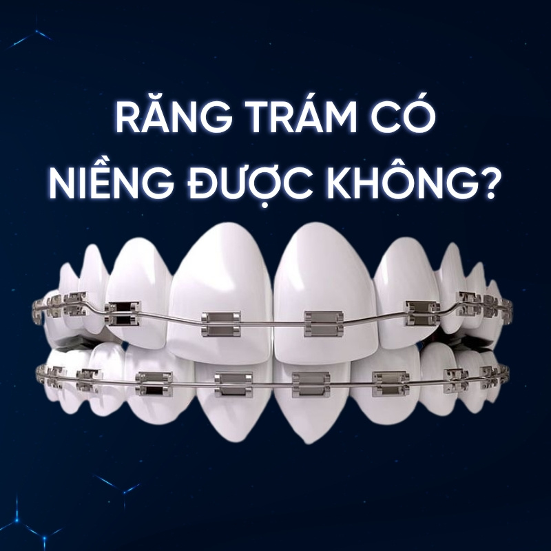 Răng trám có niềng được không smilux dental
