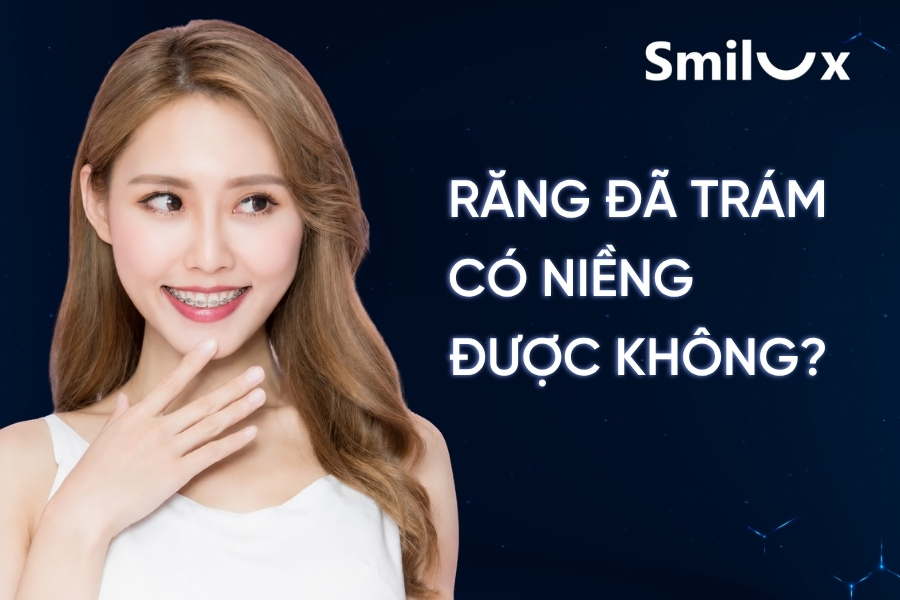 Răng trám có niềng được không? Bác sĩ Smilux Dental giải đáp Răng trám có niềng được không? Bác sĩ Smilux Dental giải đáp