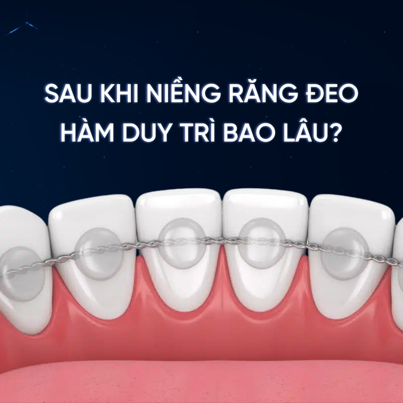 Sau khi niềng răng đeo hàm duy trì bao lâu là thắc mắc của nhiều khách hàng sau khi tháo niềng. Cùng Smilux tìm hiểu thời gian đeo hàm duy trì sau niềng răng qua bài viết dưới đây.