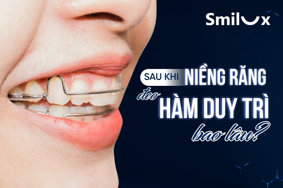 Sau khi niềng răng đeo hàm duy trì bao lâu thì tháo được? Sau khi niềng răng đeo hàm duy trì bao lâu thì tháo được?