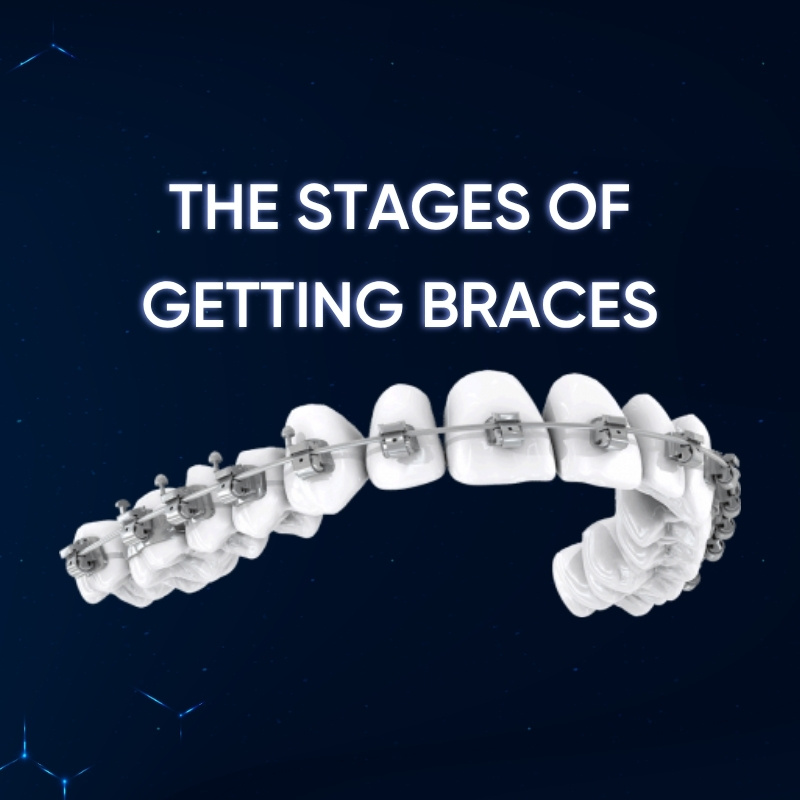 The Stages of Getting Braces