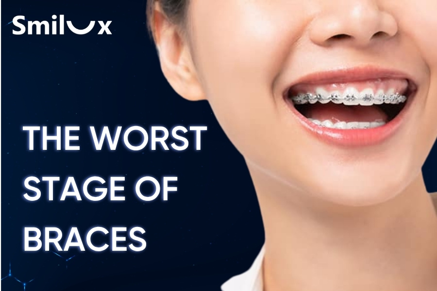 The Worst Stage of Braces and How to Overcome It The Worst Stage of Braces and How to Overcome It