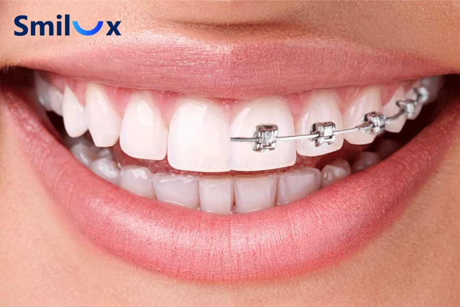 Quá trình niềng răng mất bao lâu thì xong? Quá trình niềng răng mất bao lâu thì xong?