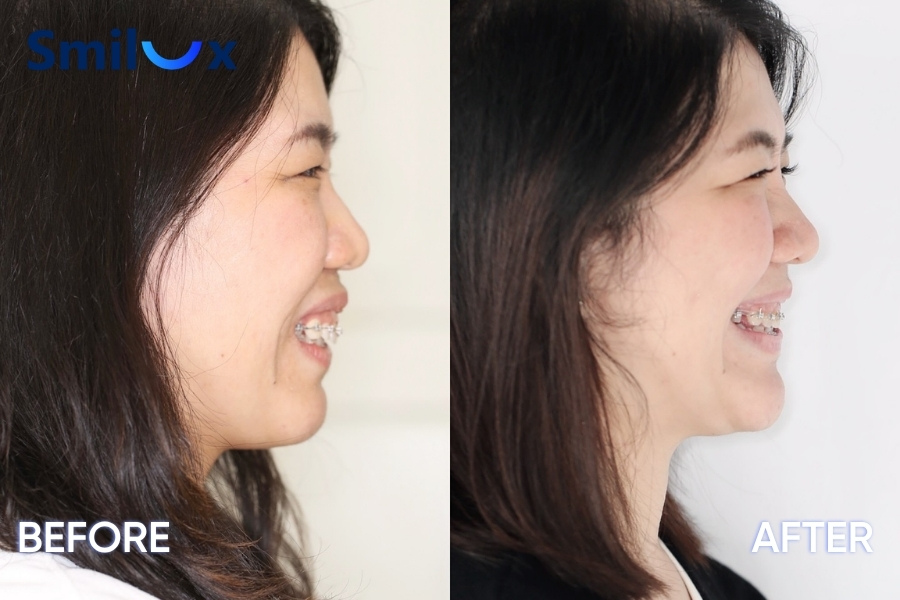 Trước và sau khi niềng răng hô Trước và sau khi niềng răng hô