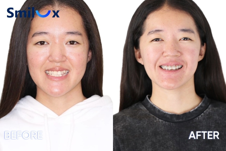 Trước và sau khi niềng răng khớp cắn hở Trước và sau khi niềng răng khớp cắn hở