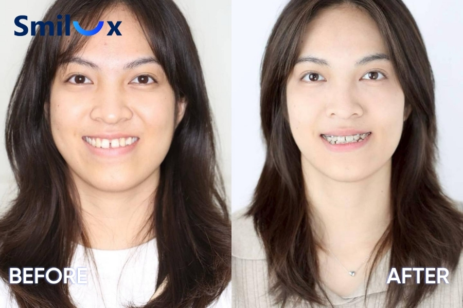Trước và sau khi niềng răng thưa Trước và sau khi niềng răng thưa