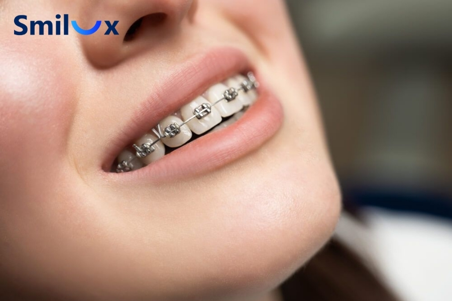 Trường hợp nào có thể niềng răng 1 hàm? Trường hợp nào có thể niềng răng 1 hàm?