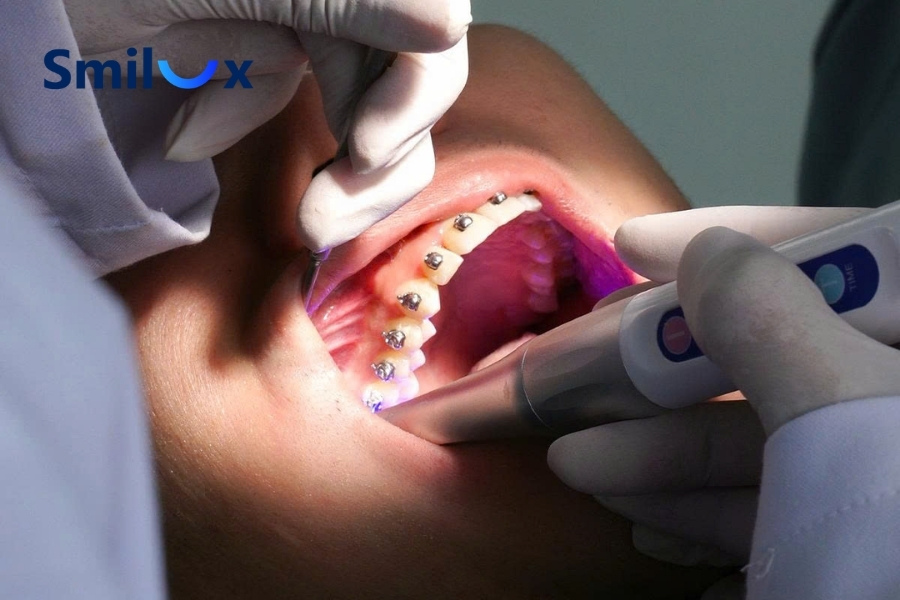 Tay nghề bác sĩ quyết định cắm vít niềng răng có đau không Tay nghề bác sĩ quyết định cắm vít niềng răng có đau không