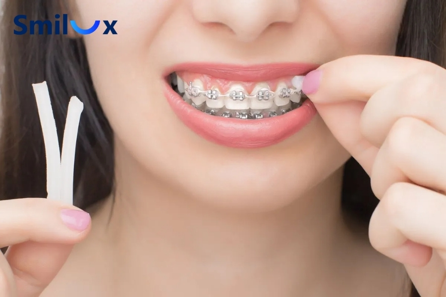 Sử dụng sáp nha khoa khi hôn Sử dụng sáp nha khoa khi hôn