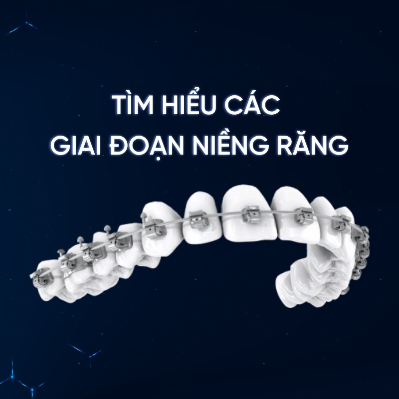 Tìm hiểu các giai đoạn niềng răng chi tiết - Smilux Dental