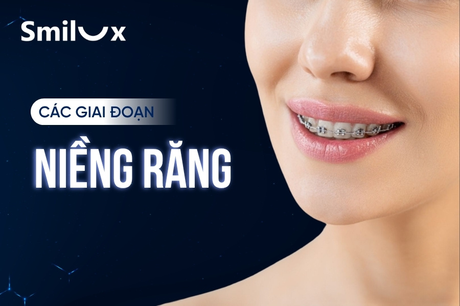 Tìm hiểu các giai đoạn niềng răng chi tiết - Smilux Dental Tìm hiểu các giai đoạn niềng răng chi tiết - Smilux Dental