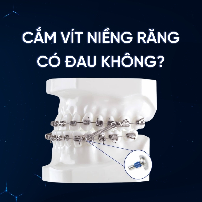 cắm vít niềng răng có đau không smilux dental