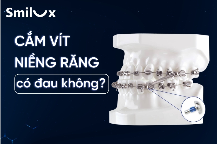 Bắn, cắm vít niềng răng có đau không? Smilux giải đáp Bắn, cắm vít niềng răng có đau không? Smilux giải đáp