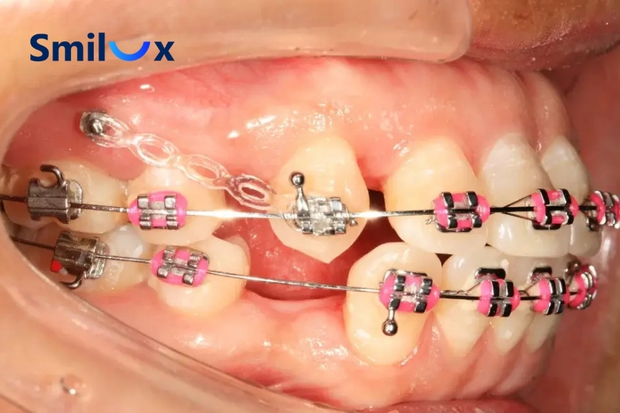 Cắm vít niềng răng diễn ra nhẹ nhàng, chỉ ê nhẹ trong thời gian ngắn Cắm vít niềng răng diễn ra nhẹ nhàng, chỉ ê nhẹ trong thời gian ngắn
