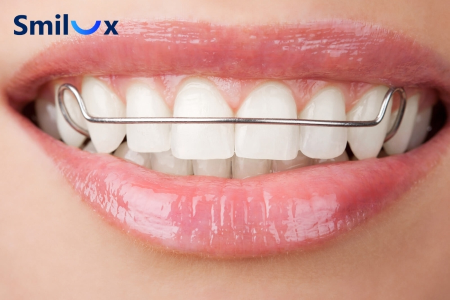 Giai đoạn tháo niềng và đeo hàm duy trì Giai đoạn tháo niềng và đeo hàm duy trì