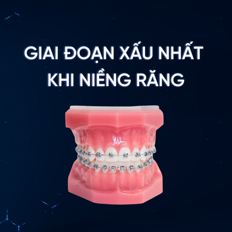 giai đoạn xấu nhất khi niềng răng smilux dental