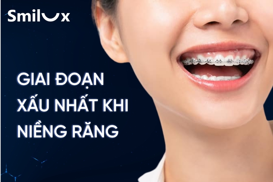 Giai đoạn xấu nhất khi niềng răng và cách vượt qua Giai đoạn xấu nhất khi niềng răng và cách vượt qua