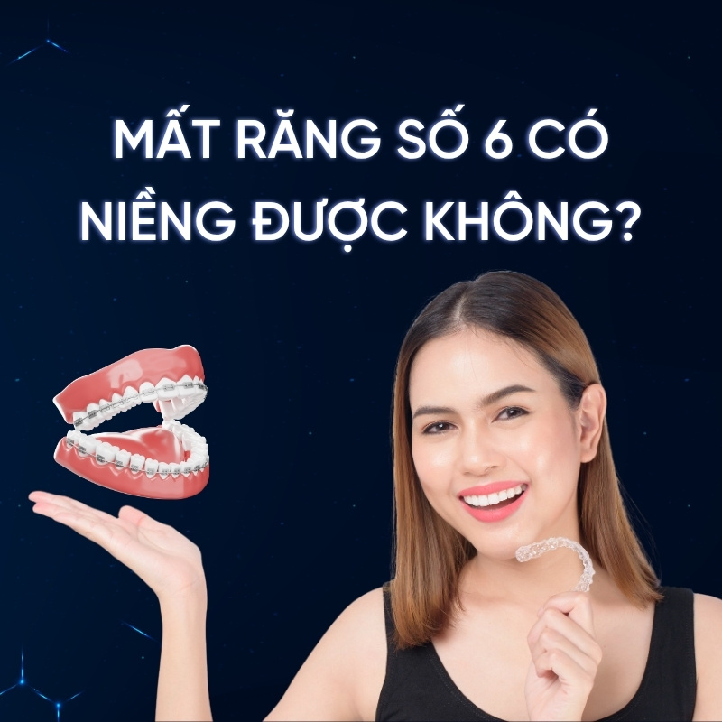 mất răng số 6 có niềng được không smilux dental