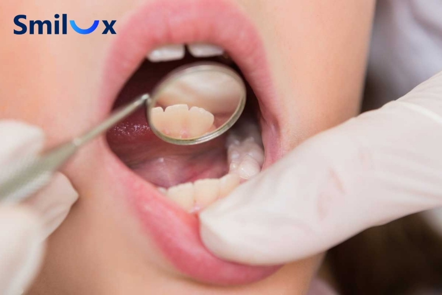 Nhổ răng khi niềng để điều chỉnh các răng sai khớp cắn Nhổ răng khi niềng để điều chỉnh các răng sai khớp cắn