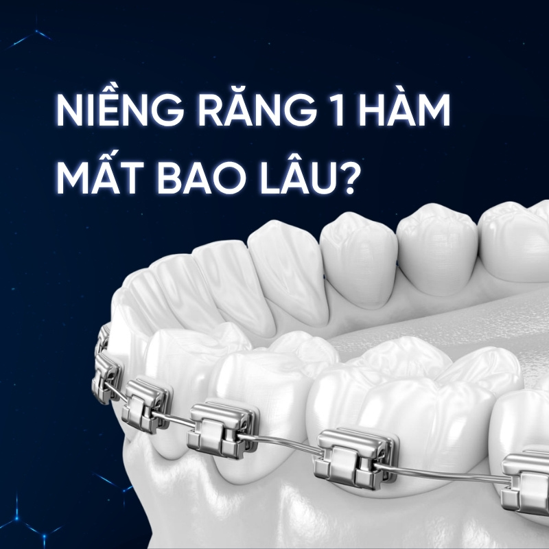 niềng răng 1 hàm mất bao lâu smilux dental