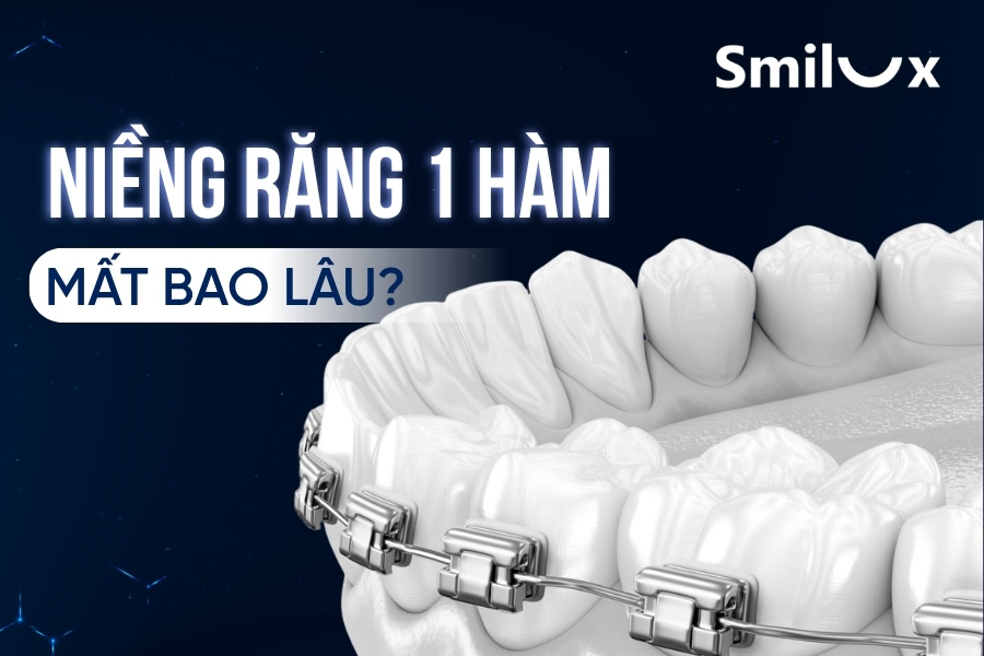 Niềng răng 1 hàm mất bao lâu? Các yếu tố ảnh hưởng thời gian niềng răng Niềng răng 1 hàm mất bao lâu? Các yếu tố ảnh hưởng thời gian niềng răng