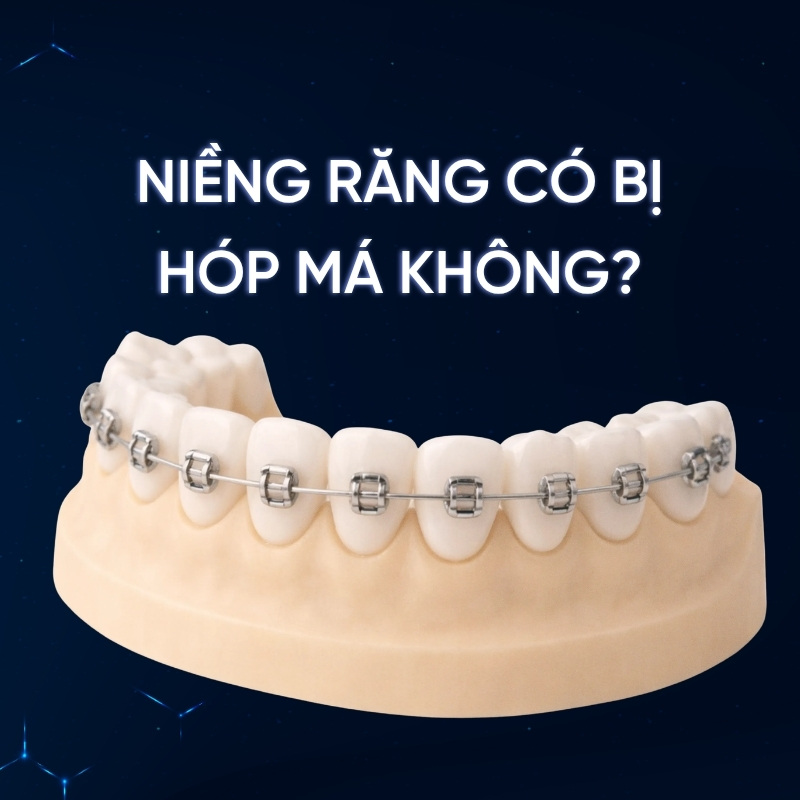 niềng răng có bị hóp má không smilux dental