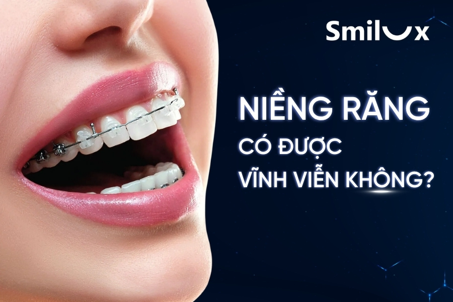 Niềng răng có được vĩnh viễn không? Tuổi thọ được bao lâu? Niềng răng có được vĩnh viễn không? Tuổi thọ được bao lâu?