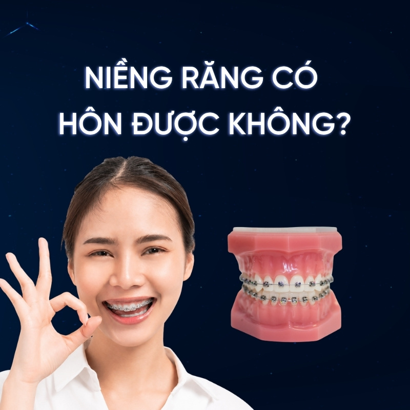 niềng răng có hôn được không smilux dental