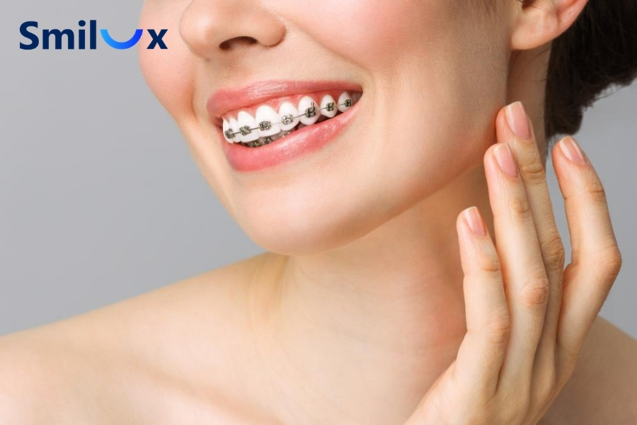 Niềng răng có giúp mũi cao hơn không? Câu trả lời là KHÔNG Niềng răng có giúp mũi cao hơn không? Câu trả lời là KHÔNG