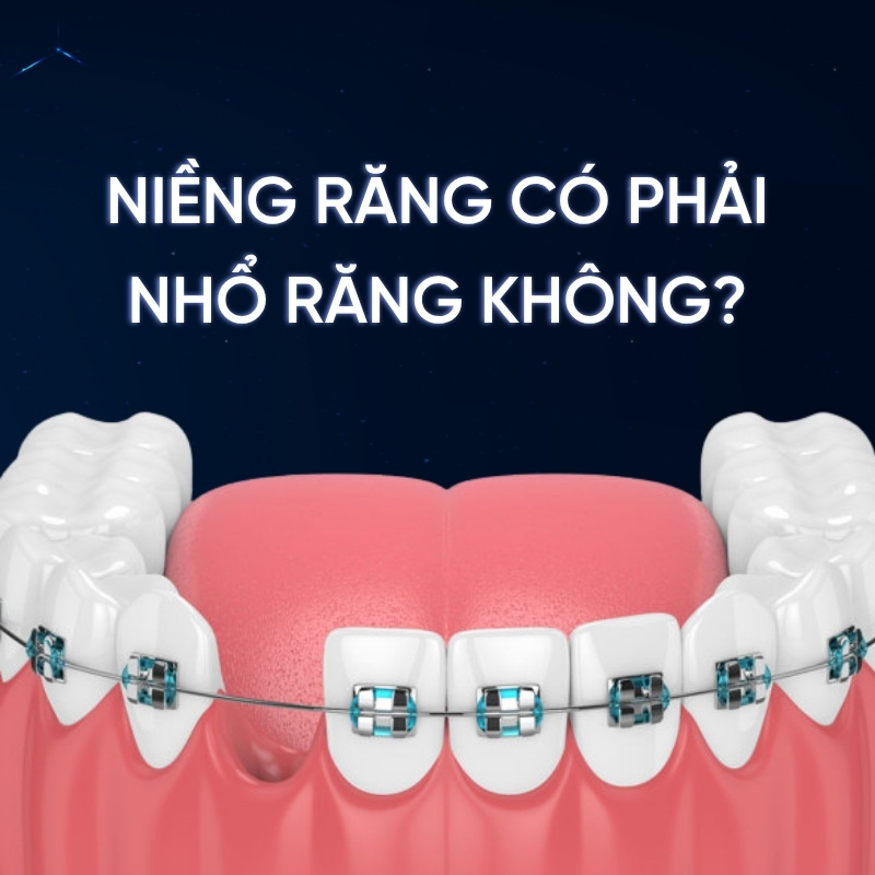 Hãy cùng lắng nghe những chia sẻ từ bác sĩ Smilux qua bài viết dưới đây để hiểu rõ hơn về vấn đề Niềng răng có phải nhổ răng không và những trường hợp cần nhổ răng trong chỉnh nha.