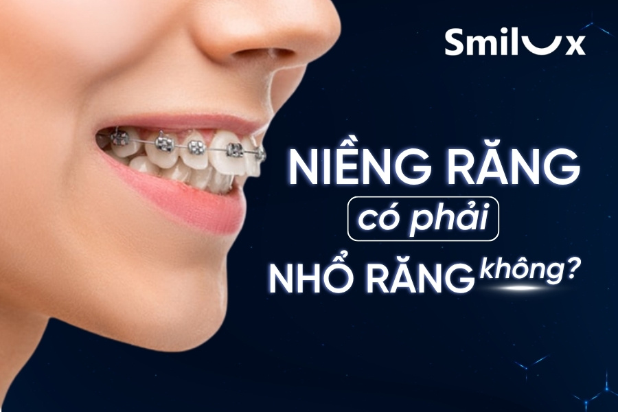 Niềng răng có phải nhổ răng không? Ai cần nhổ răng khi niềng Niềng răng có phải nhổ răng không? Ai cần nhổ răng khi niềng