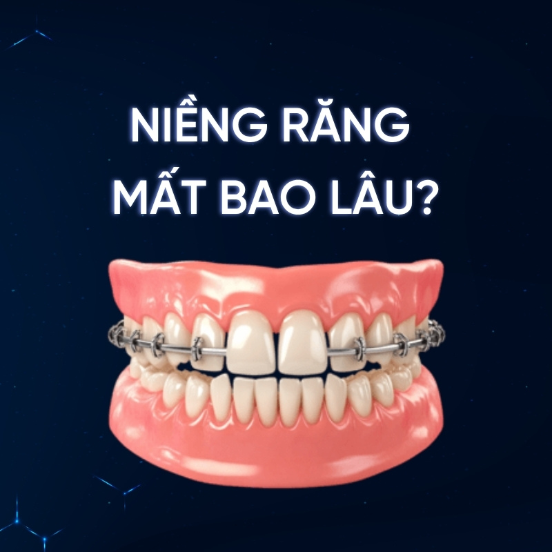 Thời gian niềng răng mất bao lâu thì xong? Các yếu tố ảnh hưởng