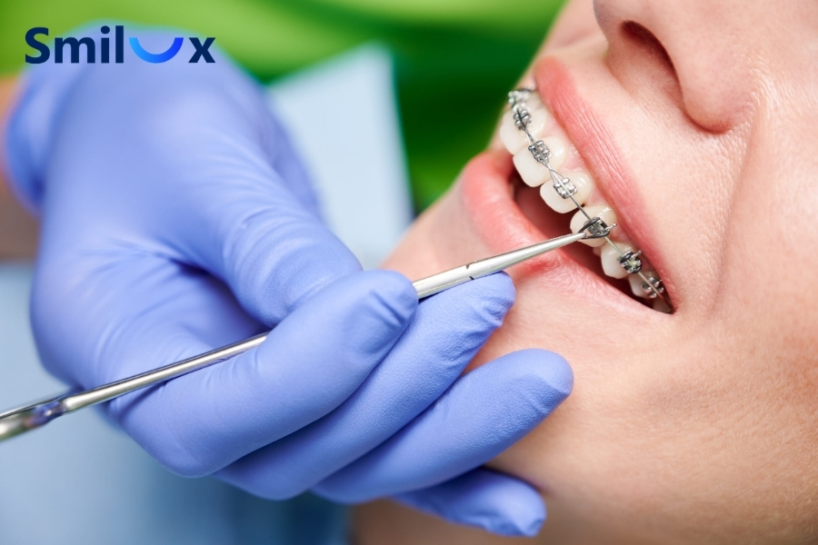 Niềng răng giúp răng dịch chuyển về đúng vị trí mà không cần mài nhỏ hay làm thay đổi cấu trúc răng thật. Niềng răng giúp răng dịch chuyển về đúng vị trí mà không cần mài nhỏ hay làm thay đổi cấu trúc răng thật.