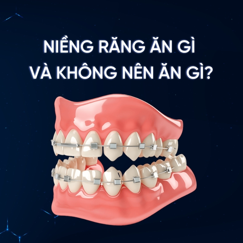 Người mới niềng răng ăn gì và không nên ăn gì để tốt cho răng dịch chuyển?