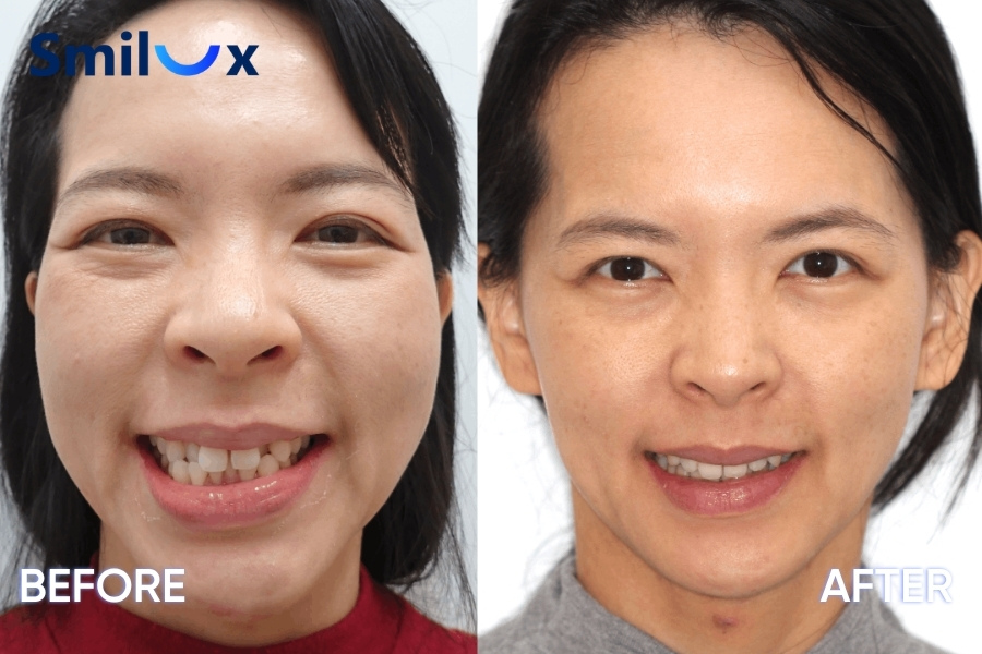 Niềng răng giúp nụ cười đẹp hơn, gương mặt thu hút hơn Niềng răng giúp nụ cười đẹp hơn, gương mặt thu hút hơn