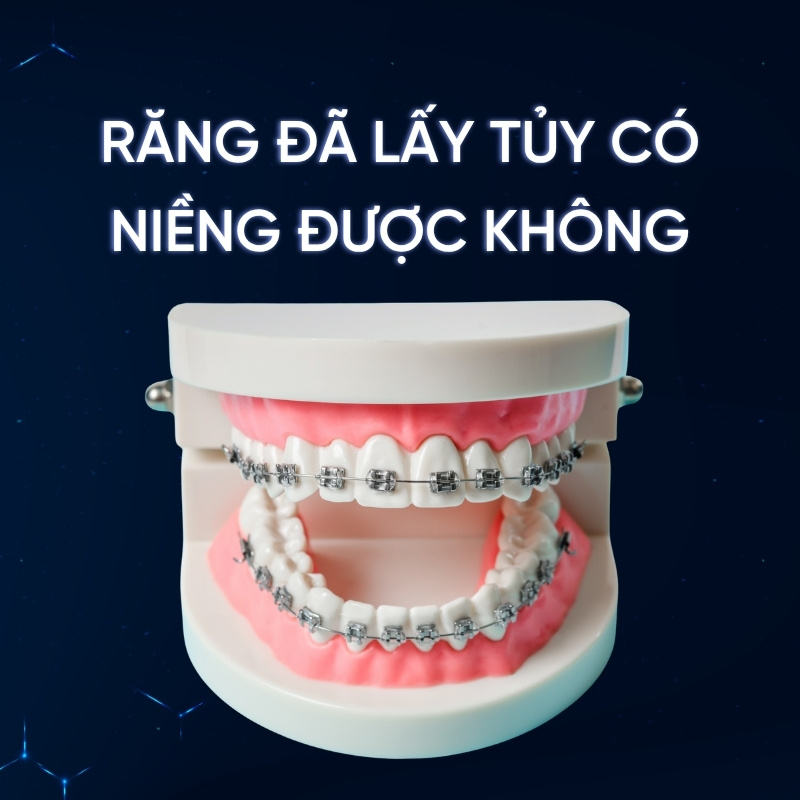 răng đã lấy tủy có niềng được không smilux dental