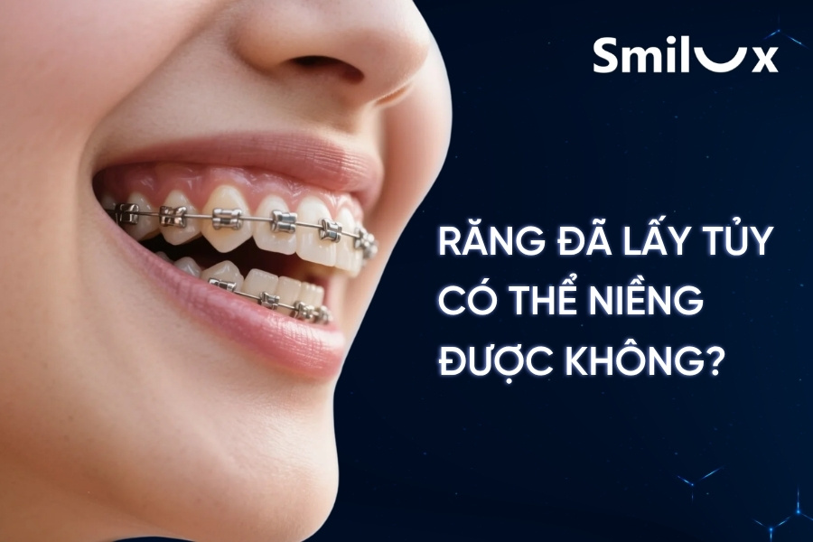 Răng đã lấy tủy có niềng được không? Một số lưu ý cần biết Răng đã lấy tủy có niềng được không? Một số lưu ý cần biết