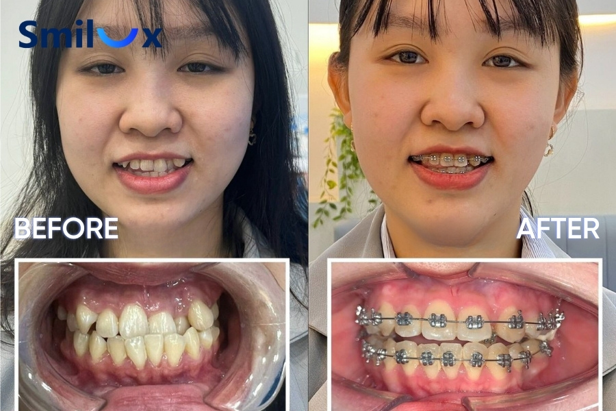 Trước và sau khi niềng răng chen chúc, lệch lạc Trước và sau khi niềng răng chen chúc, lệch lạc