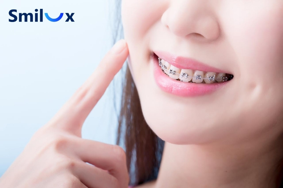 Răng bị cứng khớp có thể khó niềng sau khi bọc sứ Răng bị cứng khớp có thể khó niềng sau khi bọc sứ