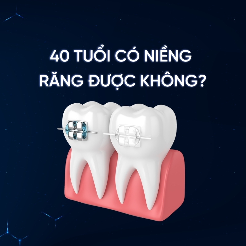 40 tuổi có niềng răng được không? Bác sĩ Smilux giải đáp chi tiết